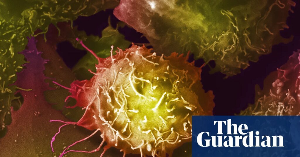 Panel de expertos desaconseja la detección del cáncer de próstata en la mayoría de los hombres en el Reino Unido | cáncer de próstata