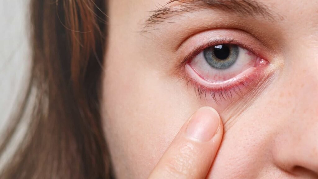 Aumentan los casos de conjuntivitis viral en consultas oftalmológicas
